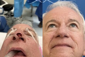 Photo of a patient before and after a procedure. This lovely patient underwent Mohs excision of basal cell carcinoma of the nasal tip. The defect was repaired with a local flap of nasal skin. The surgery actually helped to improve the nasal appearance by slightly elevating the tip. 