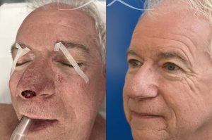Photo of a patient before and after a procedure. This lovely patient underwent Mohs excision of basal cell carcinoma of the nasal tip. The defect was repaired with a local flap of nasal skin. The surgery actually helped to improve the nasal appearance by slightly elevating the tip. 