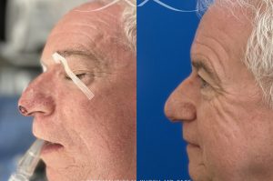 Photo of a patient before and after a procedure. This lovely patient underwent Mohs excision of basal cell carcinoma of the nasal tip. The defect was repaired with a local flap of nasal skin. The surgery actually helped to improve the nasal appearance by slightly elevating the tip. 