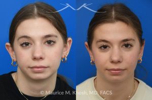 Photo of a patient before and after a procedure. Otoplasty - This young person wished to improve the  'floppy appearing ears'. She had been self conscious in wearing her hair back or exposing her ears. Ear pinning surgery, otoplasty, was performed in our Manhattan office under local anesthesia. She is delighted with the outcome of her otoplasty surgery.