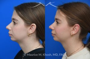 Photo of a patient before and after a procedure. Otoplasty - This young person wished to improve the  'floppy appearing ears'. She had been self conscious in wearing her hair back or exposing her ears. Ear pinning surgery, otoplasty, was performed in our Manhattan office under local anesthesia. She is delighted with the outcome of her otoplasty surgery.