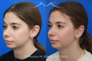 Photo of a patient before and after a procedure. Otoplasty - This young person wished to improve the  'floppy appearing ears'. She had been self conscious in wearing her hair back or exposing her ears. Ear pinning surgery, otoplasty, was performed in our Manhattan office under local anesthesia. She is delighted with the outcome of her otoplasty surgery.