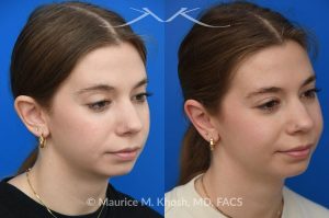 Photo of a patient before and after a procedure. Otoplasty - This young person wished to improve the  'floppy appearing ears'. She had been self conscious in wearing her hair back or exposing her ears. Ear pinning surgery, otoplasty, was performed in our Manhattan office under local anesthesia. She is delighted with the outcome of her otoplasty surgery.