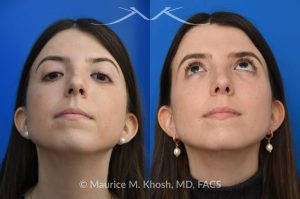 Photo of a patient before and after a procedure. Rhinoplasty for dorsal hump - This young patient wished to eliminate the hump in the bridge of her nose. A closed-approach rhinoplasty allowed removal of the nasal hump and provided her a beautiful and natural slope to the nasal bridge. She is delighted with the results of her nose job. 