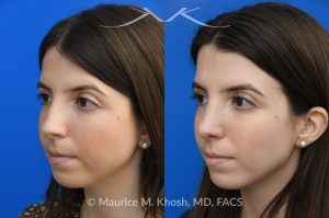 Photo of a patient before and after a procedure. Rhinoplasty for dorsal hump - This young patient wished to eliminate the hump in the bridge of her nose. A closed-approach rhinoplasty allowed removal of the nasal hump and provided her a beautiful and natural slope to the nasal bridge. She is delighted with the results of her nose job. 