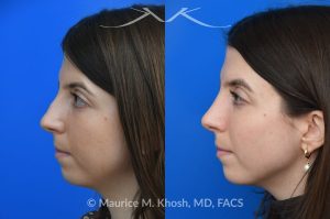 Photo of a patient before and after a procedure. Rhinoplasty for dorsal hump - This young patient wished to eliminate the hump in the bridge of her nose. A closed-approach rhinoplasty allowed removal of the nasal hump and provided her a beautiful and natural slope to the nasal bridge. She is delighted with the results of her nose job. 