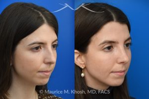 Photo of a patient before and after a procedure. Rhinoplasty for dorsal hump - This young patient wished to eliminate the hump in the bridge of her nose. A closed-approach rhinoplasty allowed removal of the nasal hump and provided her a beautiful and natural slope to the nasal bridge. She is delighted with the results of her nose job. 