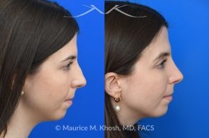 Photo of a patient before and after a procedure. Rhinoplasty for dorsal hump - This young patient wished to eliminate the hump in the bridge of her nose. A closed-approach rhinoplasty allowed removal of the nasal hump and provided her a beautiful and natural slope to the nasal bridge. She is delighted with the results of her nose job. 