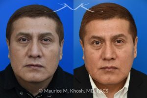 Photo of a patient before and after a procedure. Rhinoplasty for Droopy Tip - This gentleman had suffered a nasal fracture and noted breathing obstruction and poor nasal tip support which gave his nasal tip a droopy appearance. Septoplast was performed to restore his breathing. An open rhinoplasty approach was used to place bilateral septum extension grafts and a cap graft to improve the position and contour of the nose. He is ecstatic about his breathing capacity and nasal appearance following his rhinoplasty in New York.