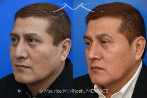 Photo of a patient before and after a procedure. Rhinoplasty for Droopy Tip - This gentleman had suffered a nasal fracture and noted breathing obstruction and poor nasal tip support which gave his nasal tip a droopy appearance. Septoplast was performed to restore his breathing. An open rhinoplasty approach was used to place bilateral septum extension grafts and a cap graft to improve the position and contour of the nose. He is ecstatic about his breathing capacity and nasal appearance following his rhinoplasty in New York.