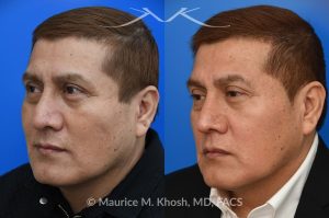 Photo of a patient before and after a procedure. Rhinoplasty for droopy tip - This gentleman had suffered a nasal fracture and noted breathing obstruction and poor nasal tip support which gave his nasal tip a droopy appearance. Septoplast was performed to restore his breathing. An open rhinoplasty approach was used to place bilateral septum extension grafts and a cap graft to improve the position and contour of the nose. He is ecstatic about his breathing capacity and nasal appearance following his rhinoplasty in New York.