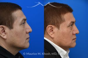 Photo of a patient before and after a procedure. Rhinoplasty for droopy tip - This gentleman had suffered a nasal fracture and noted breathing obstruction and poor nasal tip support which gave his nasal tip a droopy appearance. Septoplast was performed to restore his breathing. An open rhinoplasty approach was used to place bilateral septum extension grafts and a cap graft to improve the position and contour of the nose. He is ecstatic about his breathing capacity and nasal appearance following his rhinoplasty in New York.