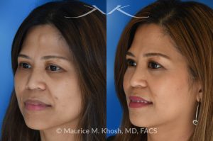 Photo of a patient before and after a procedure. Osteoma - Central forehead osteoma was removed through an invisible 1cm incision in the hairline. The osteoma removal was performed in the office under local anesthesia in our Manhattan office