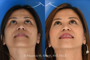 Photo of a patient before and after a procedure. Osteoma - Central forehead osteoma was removed through an invisible 1cm incision in the hairline. The osteoma removal was performed in the office under local anesthesia in our Manhattan office
