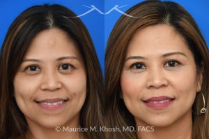 Photo of a patient before and after a procedure. Osteoma - Central forehead osteoma was removed through an invisible 1cm incision in the hairline. The osteoma removal was performed in the office under local anesthesia in our Manhattan office
