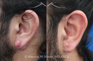 Photo of a patient before and after a procedure. Ear keloid - Left earlobe keloid excision performed in the office under local anesthesia. 
