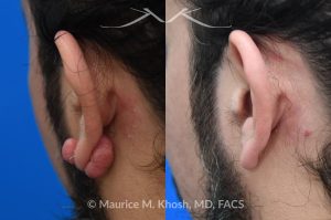 Photo of a patient before and after a procedure. Ear keloid - Left earlobe keloid excision performed in the office under local anesthesia. 
