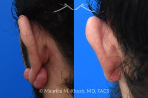 Photo of a patient before and after a procedure. Ear keloid - Left earlobe keloid excision performed in the office under local anesthesia. 
