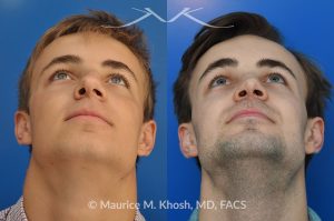 Photo of a patient before and after a procedure. Rhinoplasty for crooked nose and nasal obstruction, 10 years post op - 10 year post op results after rhinoplasty to straighten a crooked nose and alleviate severe nasal obstruction. An open approach rhinoplasty was used to achieve these results. 