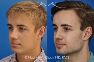 Photo of a patient before and after a procedure. Rhinoplasty for crooked nose and nasal obstruction, 10 years post op - 10 year post op results after rhinoplasty to straighten a crooked nose and alleviate severe nasal obstruction. An open approach rhinoplasty was used to achieve these results. 