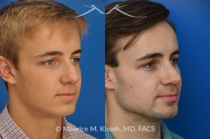 Photo of a patient before and after a procedure. Rhinoplasty for crooked nose and nasal obstruction, 10 years post op - 10 year post op results after rhinoplasty to straighten a crooked nose and alleviate severe nasal obstruction. An open approach rhinoplasty was used to achieve these results. 