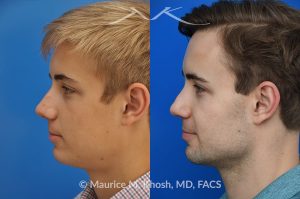 Photo of a patient before and after a procedure. Rhinoplasty for crooked nose and nasal obstruction, 10 years post op - 10 year post op results after rhinoplasty to straighten a crooked nose and alleviate severe nasal obstruction. An open approach rhinoplasty was used to achieve these results. 