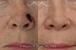 Photo of a patient before and after a procedure. Mohs repair of lower nose