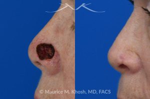 Photo of a patient before and after a procedure. Mohs repair of lower nose