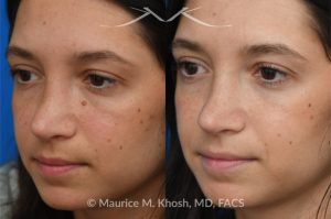 Photo of a patient before and after a procedure. Mole on the left cheek and right side of the nose