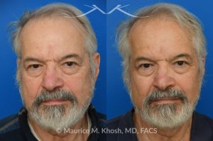 Photo of a patient before and after a procedure. Osteoma