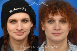 Photo of a patient before and after a procedure. Rhinoplasty to reduce hump and refine nasal tip  - before and after photos.