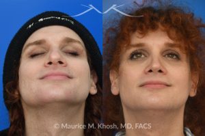Photo of a patient before and after a procedure. Rhinoplasty to reduce hump and refine nasal tip  - before and after photos.