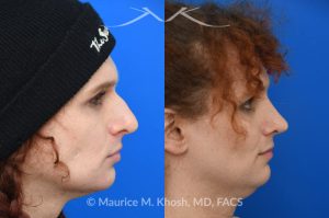 Photo of a patient before and after a procedure. Rhinoplasty to reduce hump and refine nasal tip  - before and after photos.