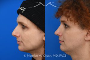 Photo of a patient before and after a procedure. Rhinoplasty to reduce hump and refine nasal tip  - before and after photos.