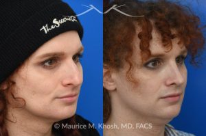 Photo of a patient before and after a procedure. Rhinoplasty to reduce hump and refine nasal tip  - before and after photos.