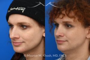 Photo of a patient before and after a procedure. Rhinoplasty to reduce hump and refine nasal tip  - before and after photos.