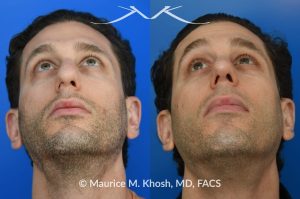 Photo of a patient before and after a procedure. Rhinoplasty for droopy tip, dorsal hump, right nasal obstruction - before and after photos.