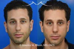 Photo of a patient before and after a procedure. Rhinoplasty for droopy tip, dorsal hump, right nasal obstruction  - before and after photos.