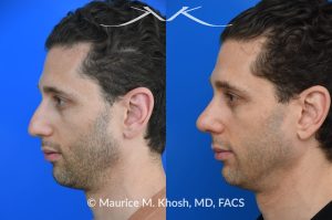 Photo of a patient before and after a procedure. Rhinoplasty for droopy tip, dorsal hump, right nasal obstruction  - before and after photos.