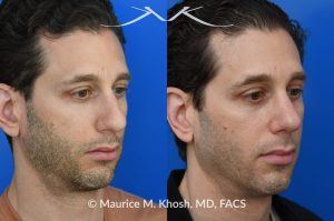 Photo of a patient before and after a procedure. Rhinoplasty for droopy tip, dorsal hump, right nasal obstruction  - before and after photos.