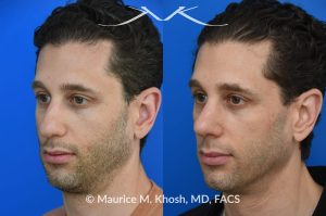 Photo of a patient before and after a procedure. Rhinoplasty for droopy tip, dorsal hump, right nasal obstruction  - before and after photos.
