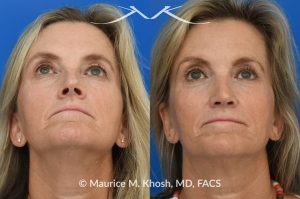 Photo of a patient before and after a procedure. Rhinoplasty to decrease nasal tip projection. Upper blepharoplasty. - before and after photos.