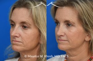Photo of a patient before and after a procedure. Rhinoplasty to decrease nasal tip projection. Upper blepharoplasty. - before and after photos.