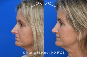 Photo of a patient before and after a procedure. Rhinoplasty to decrease nasal tip projection. Upper blepharoplasty. - before and after photos.