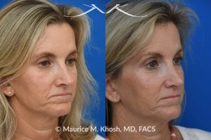 Photo of a patient before and after a procedure. Rhinoplasty to decrease nasal tip projection. Upper blepharoplasty. - before and after photos.