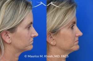 Photo of a patient before and after a procedure. Rhinoplasty to decrease nasal tip projection. Upper blepharoplasty. - before and after photos.