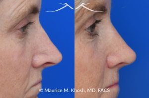 Photo of a patient before and after a procedure. Rhinoplasty to decrease nasal tip projection. Upper blepharoplasty. - before and after photos.