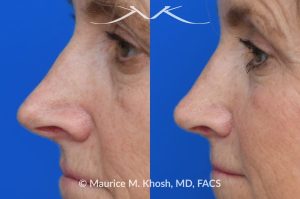Photo of a patient before and after a procedure. Rhinoplasty to decrease nasal tip projection. Upper blepharoplasty. - before and after photos.