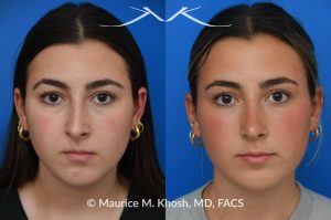 Photo of a patient before and after a procedure. Rhinoplasty to improve breathing, correct nasal deviation, and reduce nasal hump  - before and after photos.