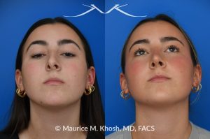 Photo of a patient before and after a procedure. Rhinoplasty to improve breathing, correct nasal deviation, and reduce nasal hump  - before and after photos.
